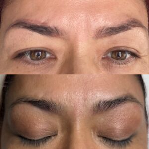 Eyebrow laser removal