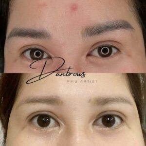 Eyebrow laser removal