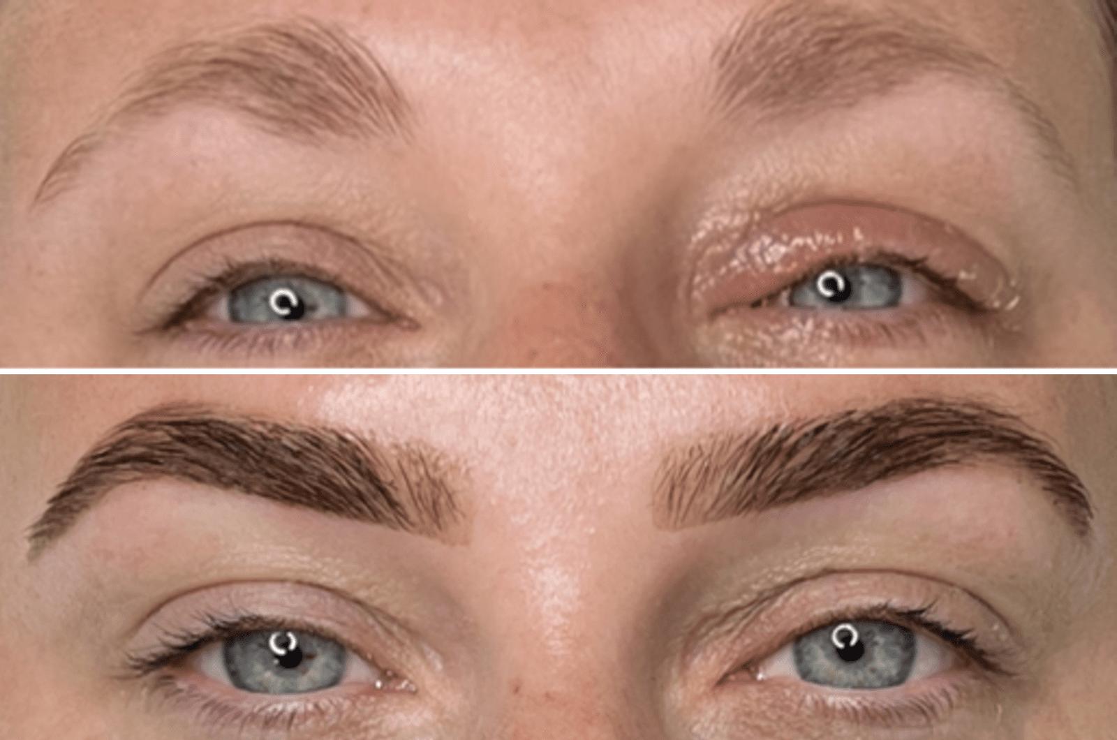 Uneven brow shape before/after correction
