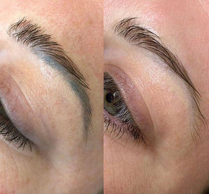 Dark blue old tattoo before/after Pico removal